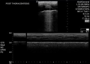 Assessment for pneumothorax after throacentesis. Note M-mode image confirming the "sea shore" sign, ruling out pneumothorax
