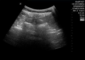 Ultrasound image in the sagital plane