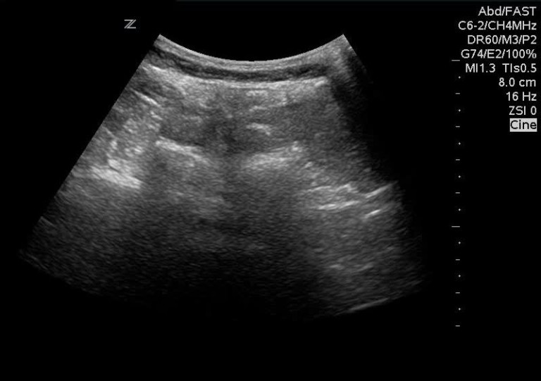 Difficult Lumbar Puncture? Ultrasound to the rescue! - The EM Pulse