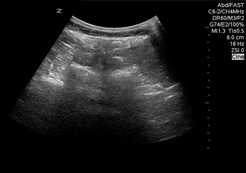 Difficult Lumbar Puncture? Ultrasound to the rescue! – ZuckerEM @ Northwell