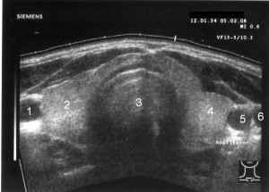 Tracheal Ultrasound POCUS