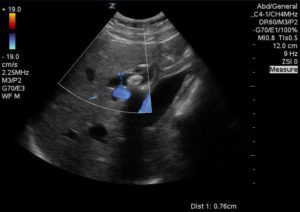 choledocholithiasis